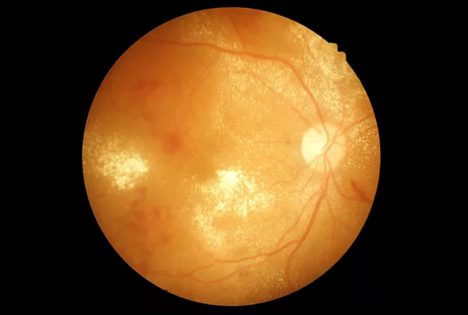 Diabetic Retinopathy