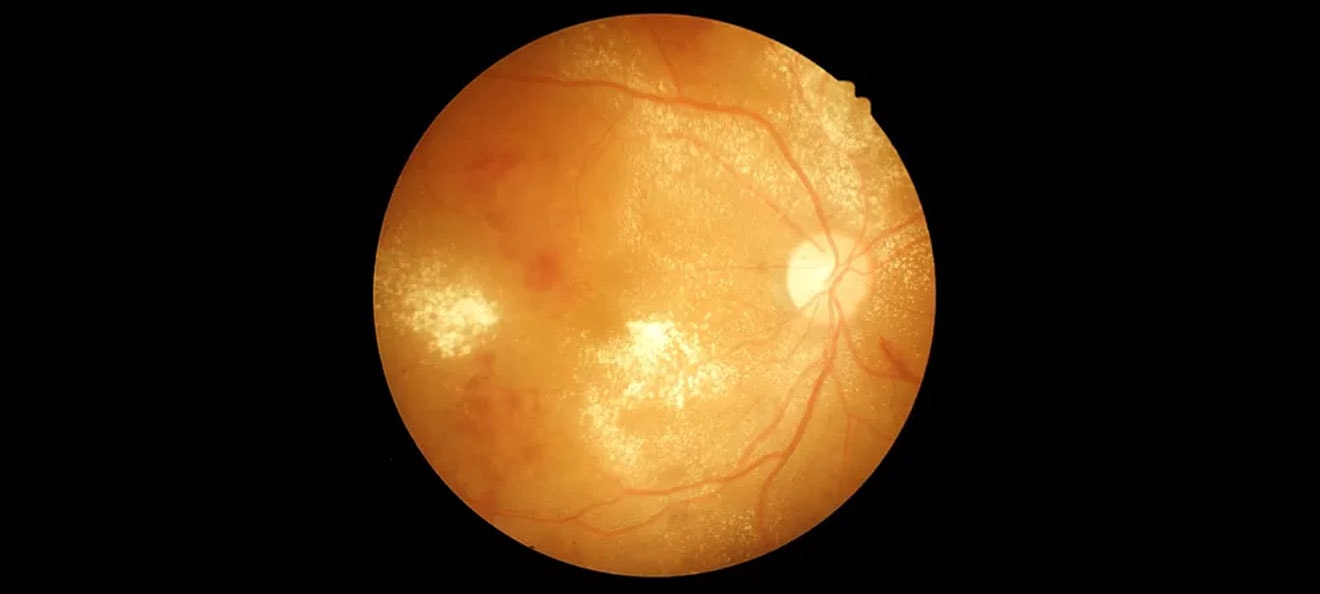 Diabetic Retinopathy