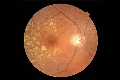 Macular Degeneration