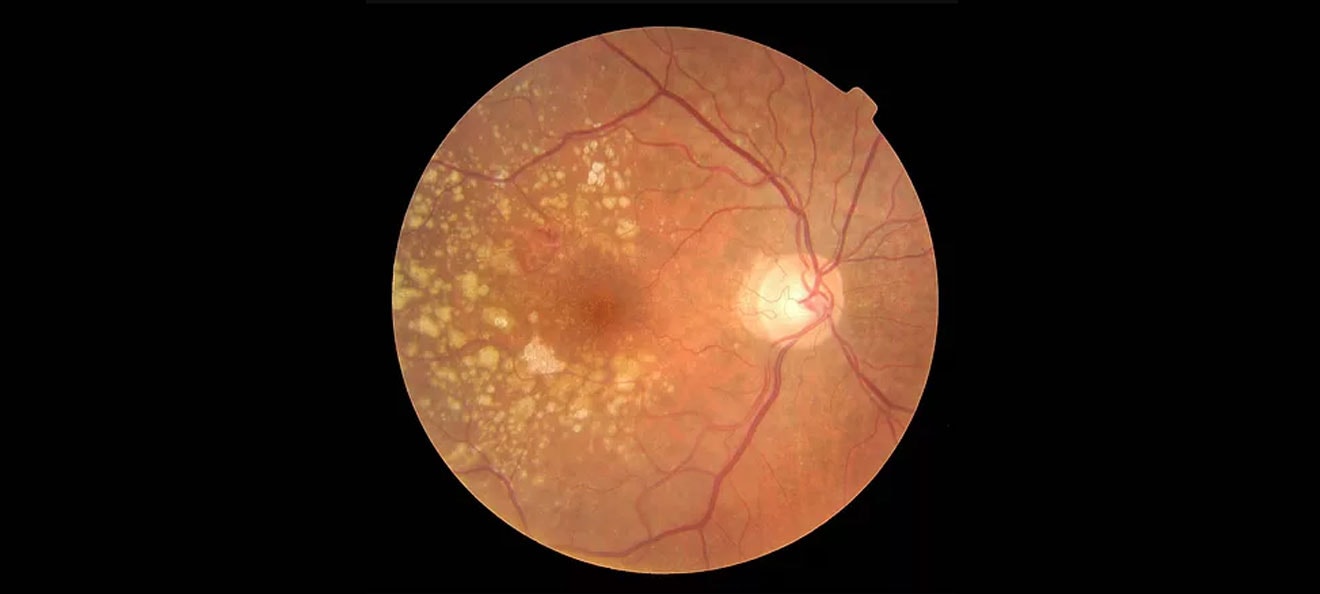 Macular Degeneration