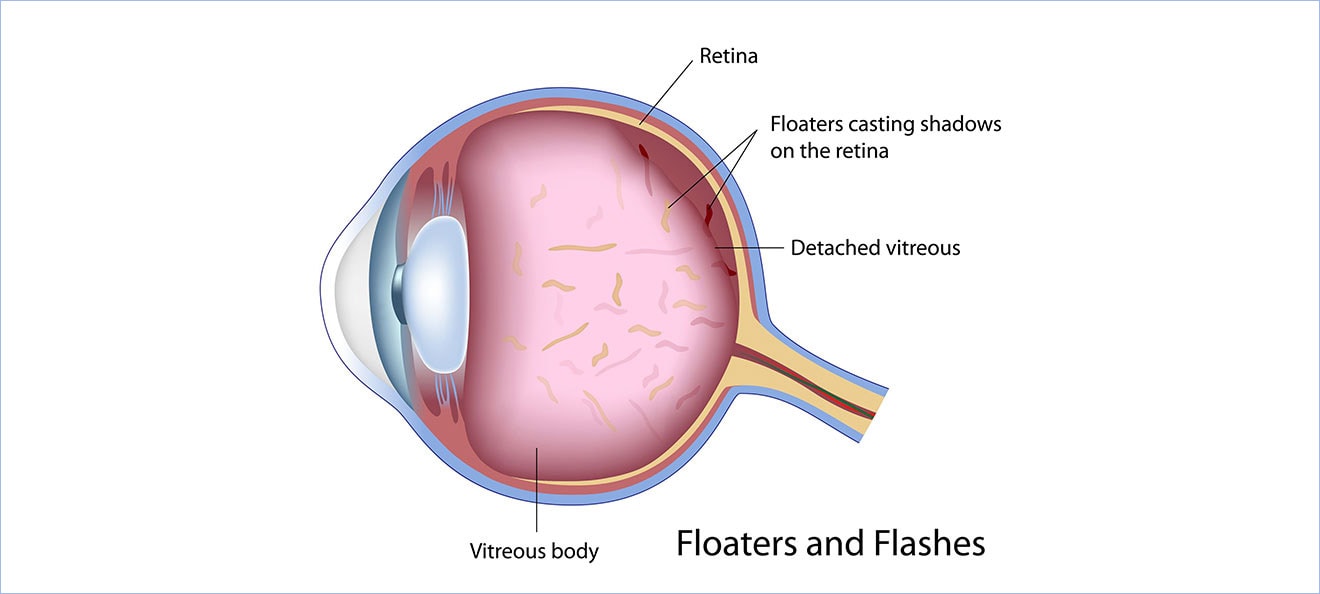 Spots Floaters New